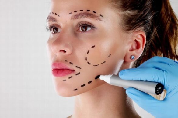 Woman with facial marking lines showing non-surgical facelift treatment areas and procedures